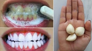 Blanchir ses dents naturellement en 2 minutes. Soin des dents à la maison