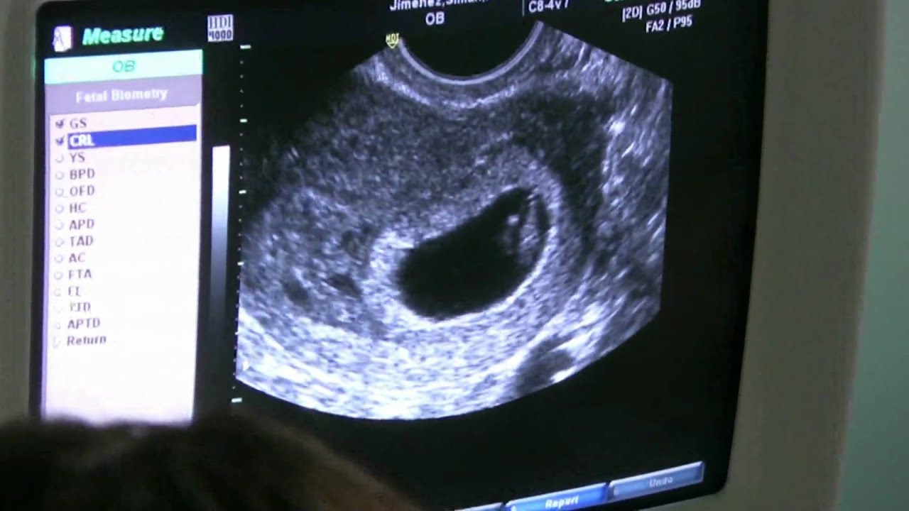 Renee and Ben's Sonogram: Baby's Heartbeat 7 weeks 2 days - YouTube
