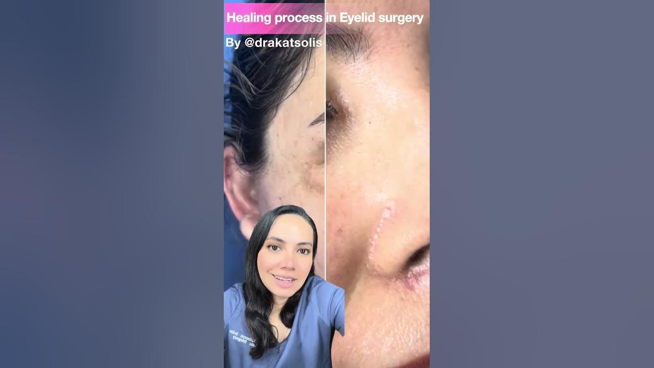eyelid-surgery-healing-process-youtube