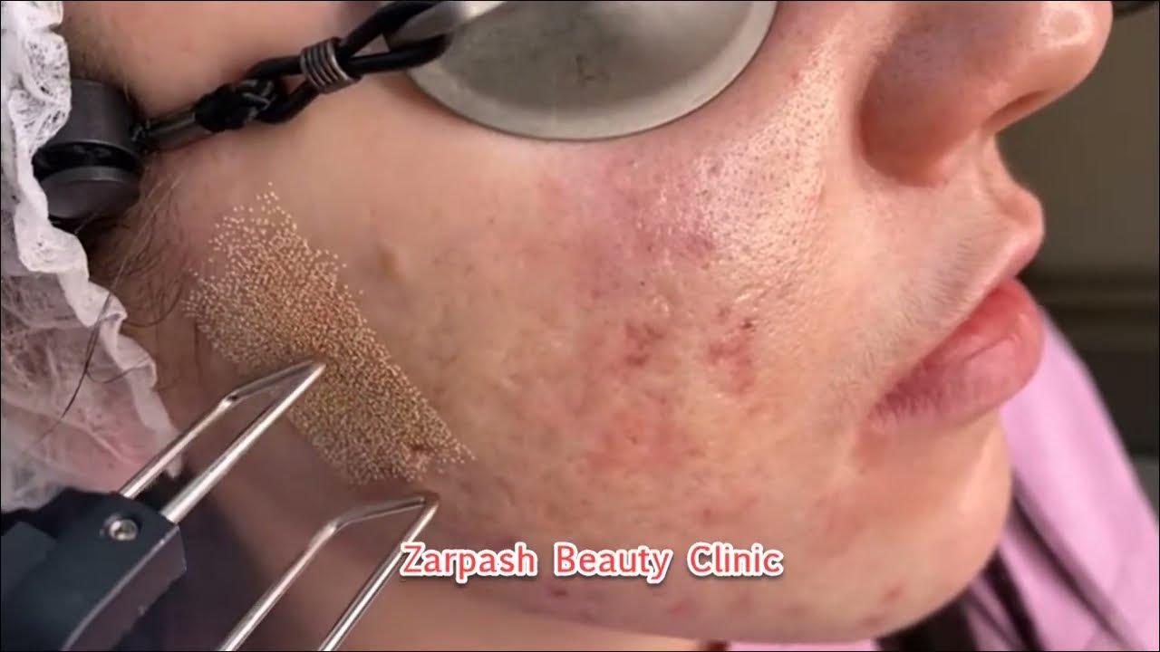 The best way to get beautiful, even skin at Zarpash beauty clinic YouTube