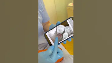 Отсутствие зачатка постоянного зуба