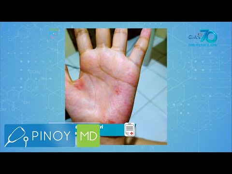 Video: 3 Mga paraan upang Itigil ang Eczema mula sa Pagkalat