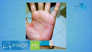Pinoy MD: Paano maiiwasan ang pangagati dulot ng eczema?