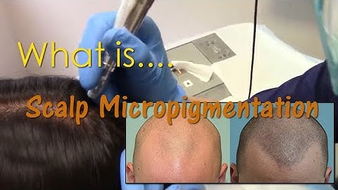 Scalp Micro Pigmentation Explained by Sara Wasserbauer, MD (2)