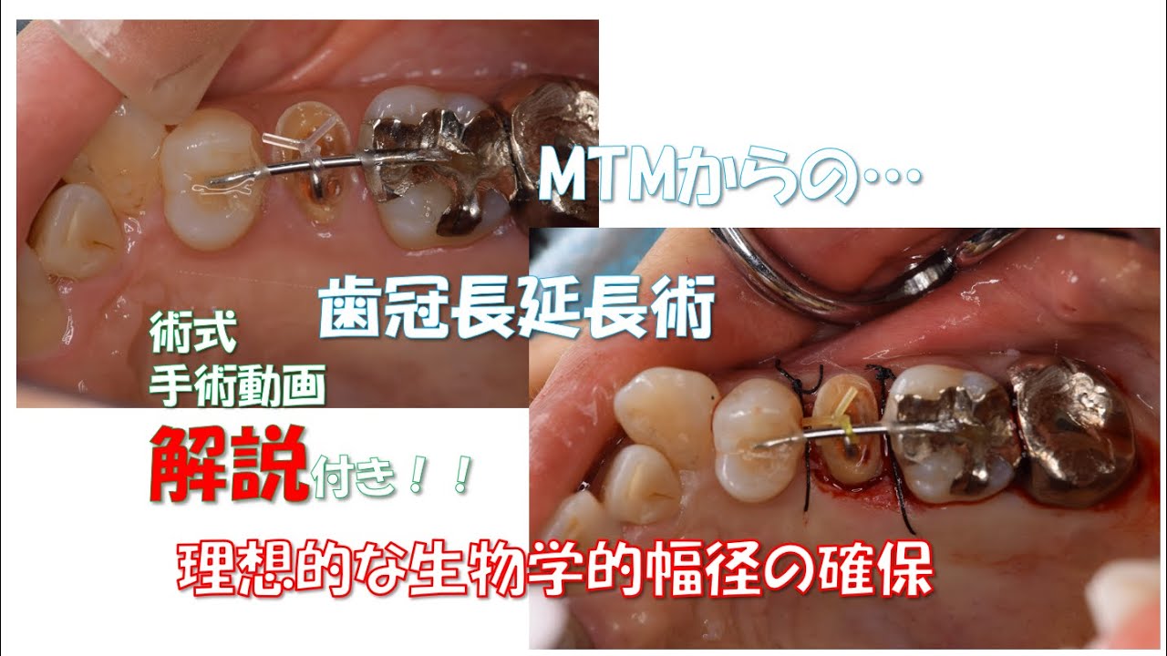 ⭕️クリニカルポケットガイド　モビライゼーションテクニック クリニカルポケットガイド モビライゼーションテクニック／医歯薬出版