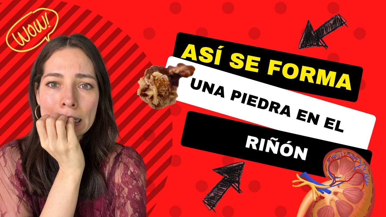¿Cómo se forman las piedras del riñon? - YouTube