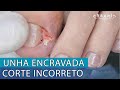 UNHA ENCRAVADA POR CORTE INCORRETO | PROCEDIMENTO COM ÓRTESE METÁLICA