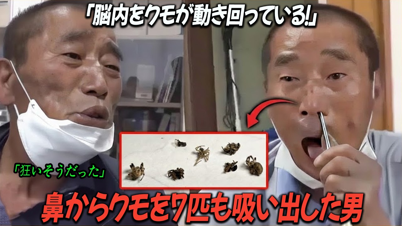 【実話】「脳内をクモが動き回っている!」それを証明するために、この男は自分の鼻からクモを7匹も吸い出した!彼は24時間ずっと苦しみの中で生きている!