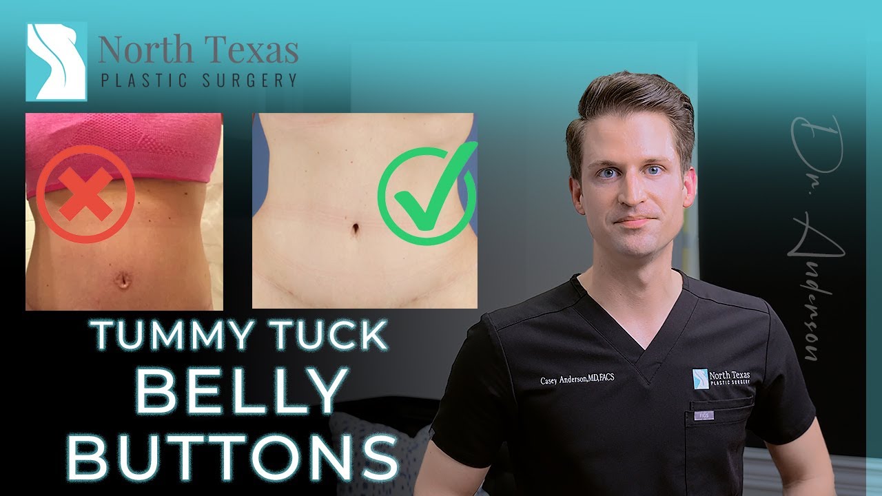 Belly Buttons  The Most Important Part of a Tummy Tuck 
