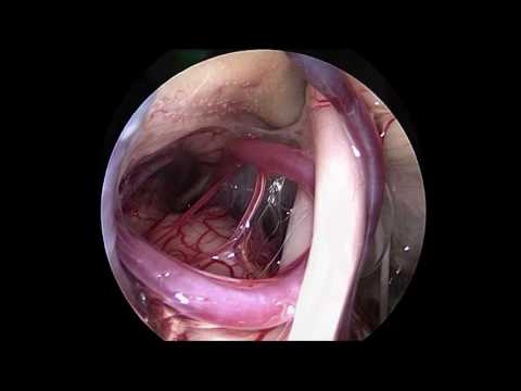 Youtube Microvascular Decompression Trigeminal Neuralgia