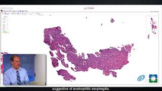 Pathology Insights: Issues With Esophageal Biopsies With a Focus on Barrett’s Esophagus