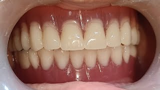 Happy Complete Denture patient with Neutral Zone