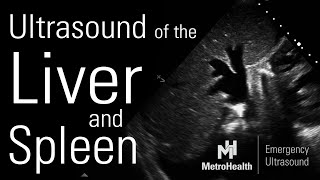 Ultrasound of the Liver \& Spleen
