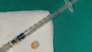 sebaceous cyst in the scalp screenshot 5