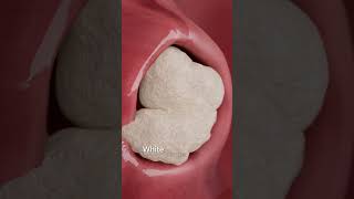 How Tonsil Stones Form 🤮 #shorts