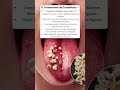 ¿Como tratar la candidiasis? #candidiasis #candida #medicina #salud