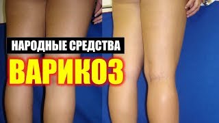 ✅Народные Мочегонные Средства при Отеках Ног. Лечение и Профилактика Варикоза