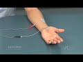 Electrode placement for thumb abduction