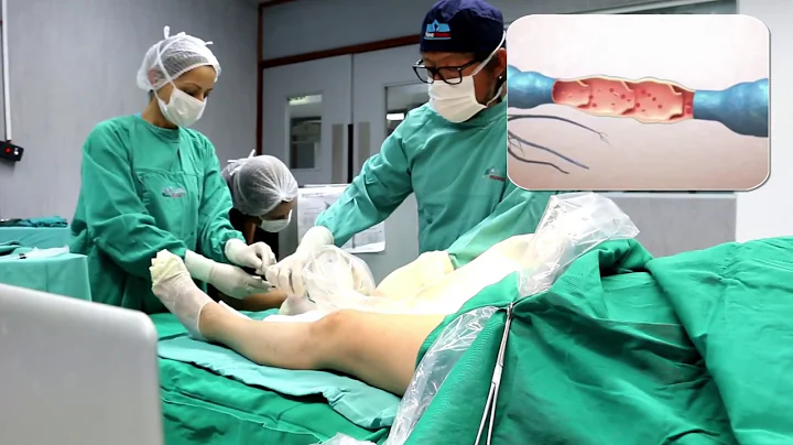 Ciruga de Vrices Endoluminal - Dr. Manuel Adrianzen