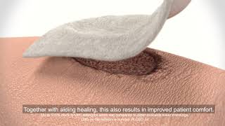 Pluto Ag SFM's novel Reinforced Antibacterial Alginate Dressing