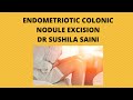 Endometriotic coloniccnodule excision  laproscopy surgery at jaipur doorbeen hospital