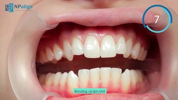 KỸ THUẬT GẮN ATTACHMENT  | CHỈNH NHA TRONG SUỐT NPALIGN VIỆT NAM