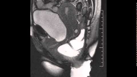 Dynamic MRI showing rectal intussusception