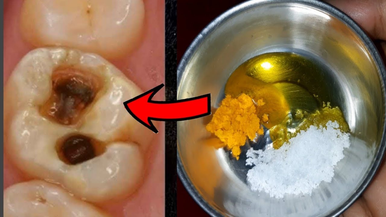 ಎಷ್ಟೇ ಭಯಂಕರವಾದ ಹಲ್ಲು ನೋವಾದ್ರೂ ನಿಮಿಷದಲ್ಲಿ ಪರಿಹಾರ // teeth pain in