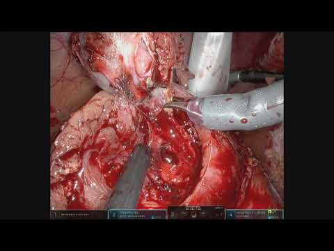 robotic partial nephrectomy with per operative  ultrasound    Dr Jerome Parra