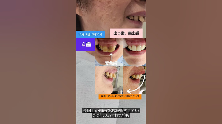 『YouTuberヒカルさんのYouTubeをみて！』60代のモニター様。ヒカルさんがYouTubeで私のことを話してくださったのを観て施術を委ねていただきました。ヒカル砲の威力に感謝です#ヒカル