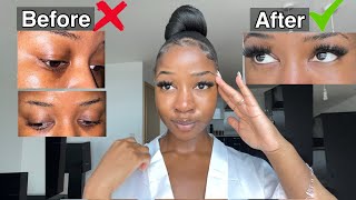 HOW TO GET RID OF DARK CIRCLES PERMANENTLY!! 👀 (Fast and Effective)