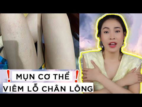 Điều Trị Mụn Lưng Và Viêm Nang Lông - Khắc phục nhanh MỤN CƠ THỂ , VIÊM LỖ CHÂN LÔNG  ❗ mụn lưng , mụn nắp tay ,da body sần sùi xấu xí ❗