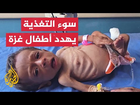أوضاع صعبة تواجه أطفال غزة في مستشفى الرنتيسي جراء التجويع