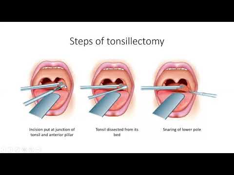 Tonsillectomy | ENT Lecture Series