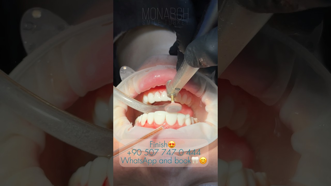 Monarch Smile Turkey — patient video