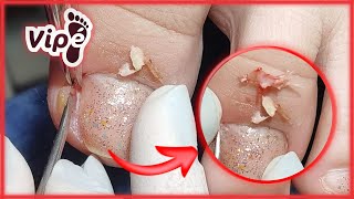 OVERGROWN INFECTED INGROWN TOENAIL REMOVAL