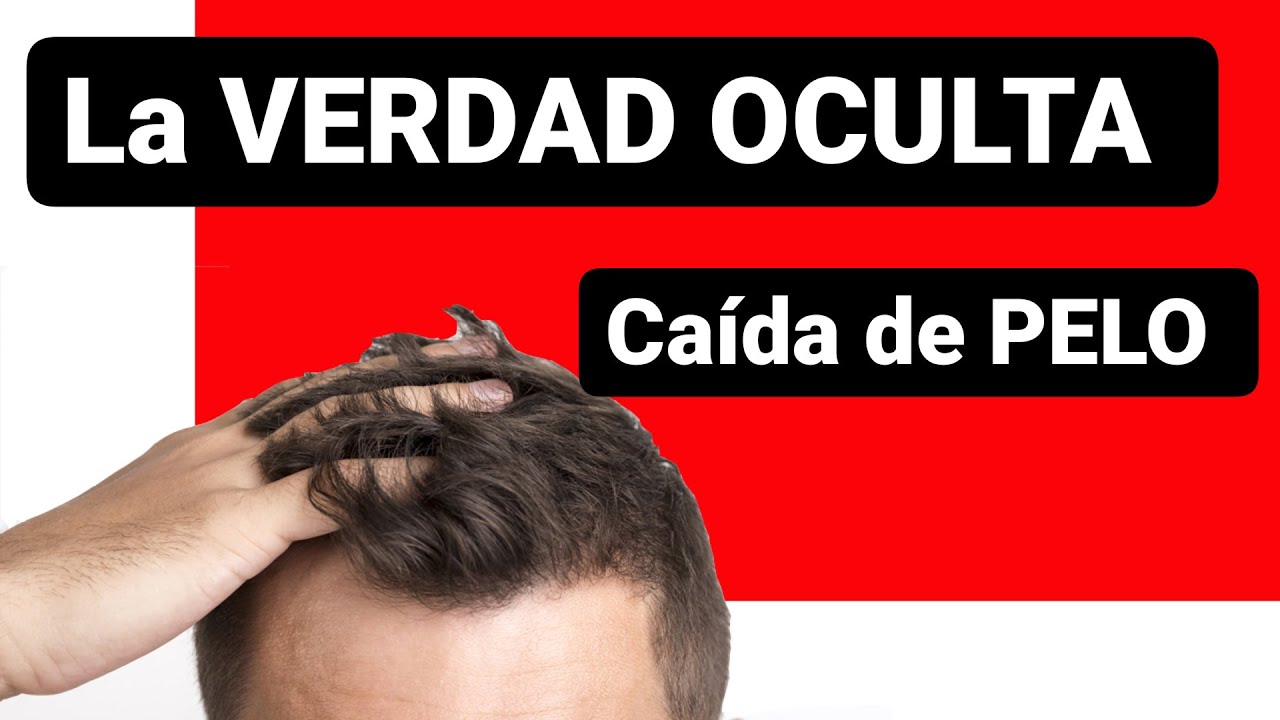 CAÍDA de CABELLOS HOMBRES Causas 2020
