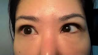 Opsoclonus in a Patient Before Treatment