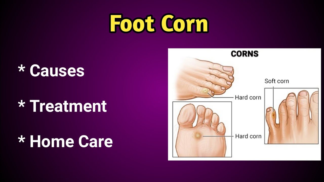 Foot Corn Causes, Treatment and Home care YouTube