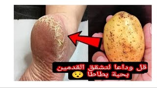 علاج تشقق القدمين بمواد موجودة في كل بيت