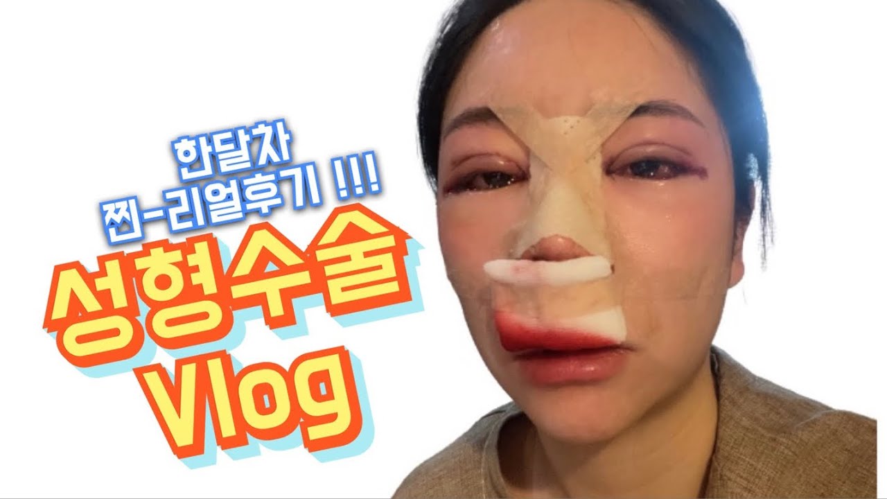 💸내돈내산 💸성형수술vlog/리얼후기✨/D-1부터한달차까지