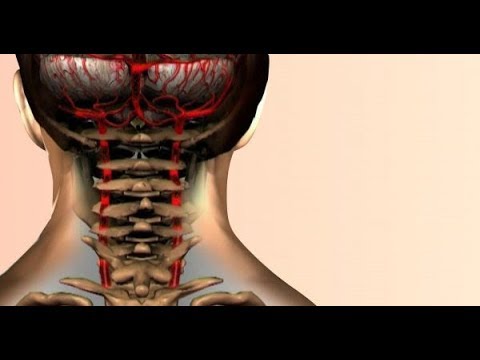 Vídeo: Violación De La Circulación Cerebral En La Osteocondrosis Cervical: Tratamiento, Síntomas