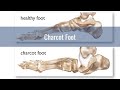 Charcot foot  what you need to know