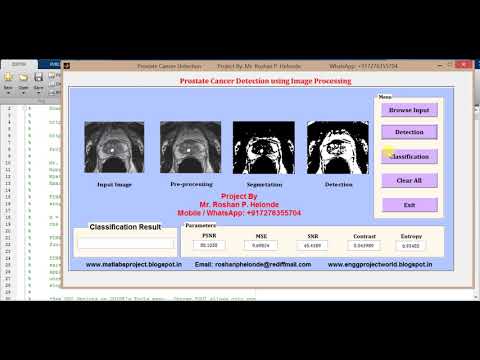 Matlab Code for Prostate Cancer Detection using Image Processing