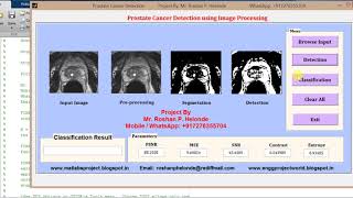 Matlab Code for Prostate Cancer Detection using Image Processing