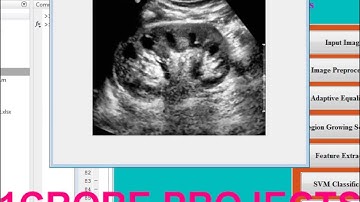 Smartphone Based Automatic Abnormality Detection of Kidney in Ultrasound Images - 1Crore Projects