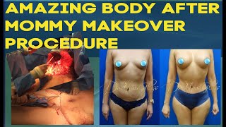 Mommy Makeover Procedure To Achieve Amazing Body | Dr.Cortes | Plastic Surgeon
