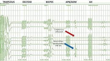 Transcranial Motor Evoked Potentials: An Overview