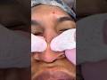 Men’s Nose Extractions