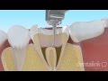 Endodoncia - EXPLICACIÓN A PACIENTES-  Dentalink Software Dental